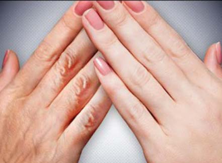 کرم برای لکه های روی دست 